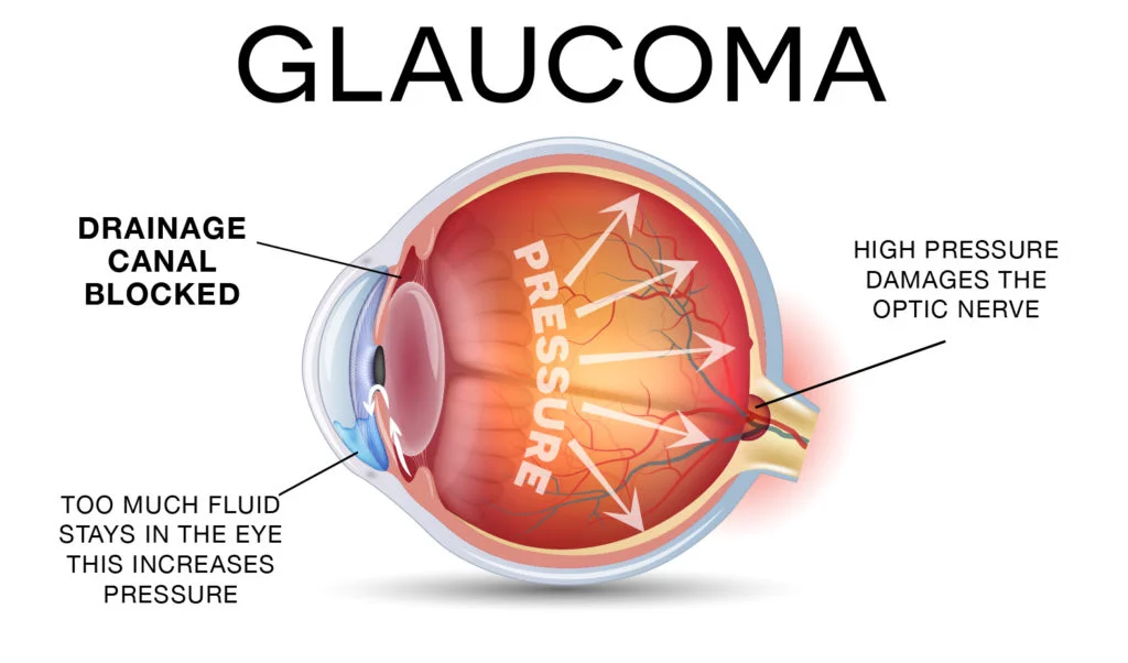 Glaucoma Care and Treatment at Best Eye Hospital in Hyderabad